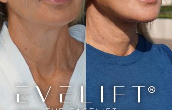 female patient before and after EVELift®