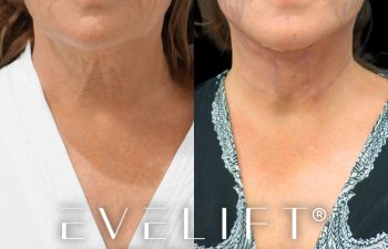 female patient before and after EVELIFT®