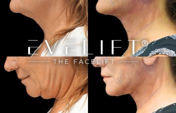 female patient before and after EVELIFT®