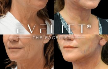 female patient before and after EVELIFT®
