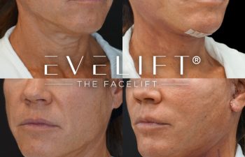 female patient before and after EVELIFT®