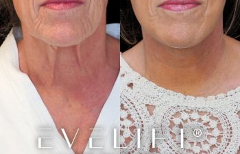 female patient before and after EVELIFT®