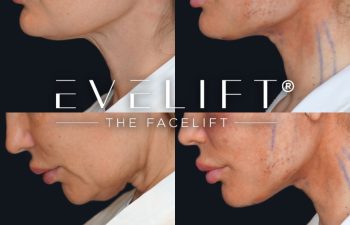 female patient before and after EVELift®