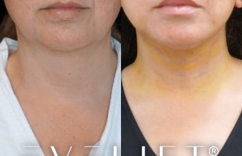 female patient before and after EVELIFT®
