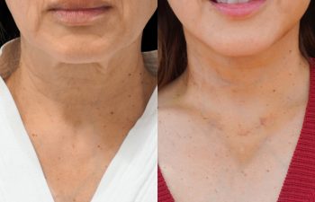female patient before and after EVELIFT®