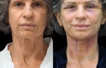female patient before and after EVELIFT®