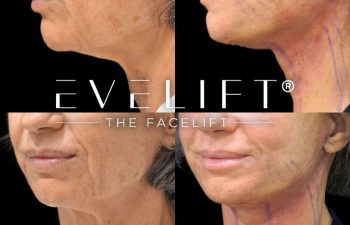 female patient before and after EVELIFT®