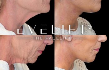 female patient before and after EVELIFT®
