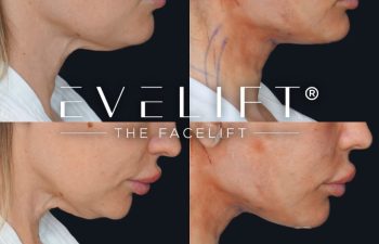 female patient before and after EVELift®