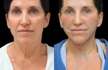 female patient before and after EVELift®