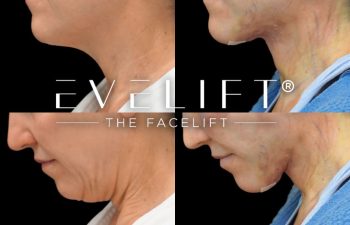 female patient before and after EVELift®