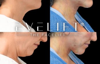 female patient before and after EVELift®