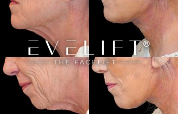female patient before and after EVELIFT®