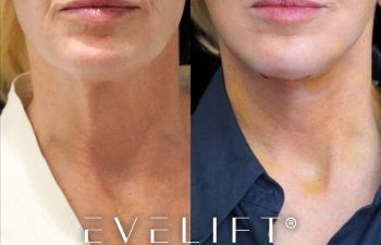 female patient before and after EVELIFT®