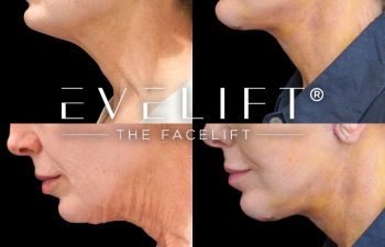 female patient before and after EVELIFT®