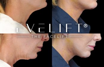 female patient before and after EVELIFT®