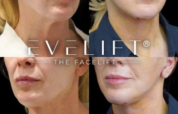 female patient before and after EVELIFT®