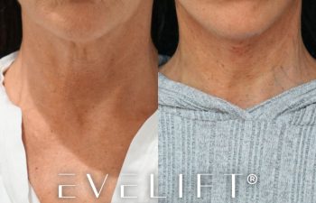 female patient before and after EVELIFT®