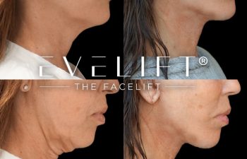 female patient before and after EVELIFT®