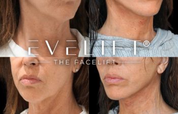 female patient before and after EVELIFT®