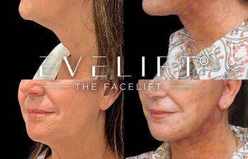 female patient before and after EVELIFT®
