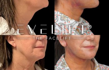 female patient before and after EVELIFT®