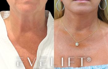 female patient before and after EVELIFT®