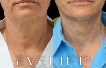 female patient before and after EVELIFT®
