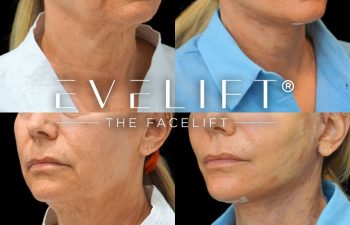 female patient before and after EVELIFT®