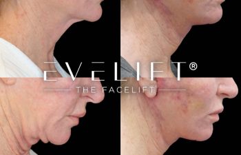 female patient before and after EVELift®