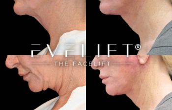 female patient before and after EVELift®