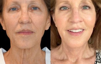 female patient before and after EVELIFT®