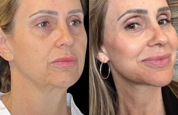 female patient before and after EVELIFT®