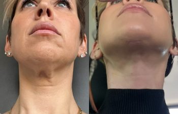 female patient before and after EVELift®