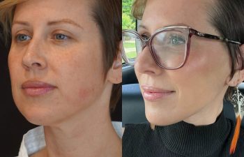 female patient before and after EVELift®