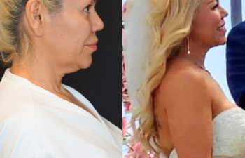female patient before and after EVELift®