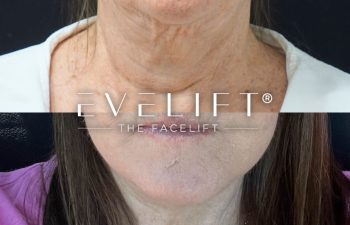female patient before and after EVELift®