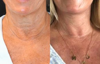 female patient before and after EVELIFT®