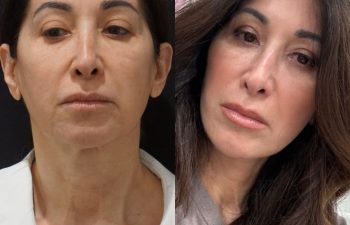 female patient before and after EVELift®
