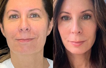 female patient before and after EVELIFT®