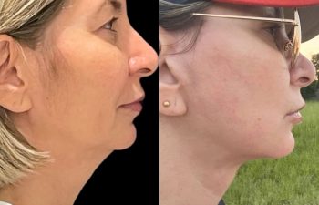 female patient before and after EVELIFT®