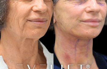 female patient before and after EVELIFT®