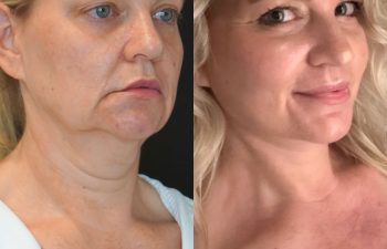female patient before and after EVELift®