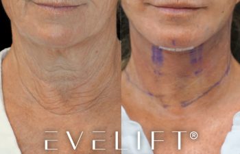 female patient before and after EVELIFT®