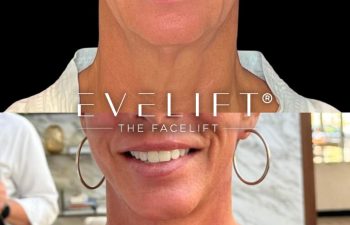 female patient before and after EVELIFT®
