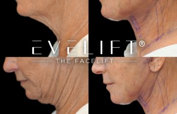 female patient before and after EVELIFT®