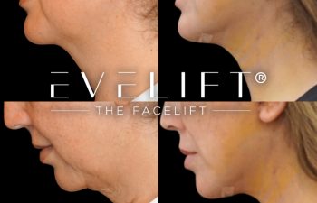 female patient before and after EVELIFT®
