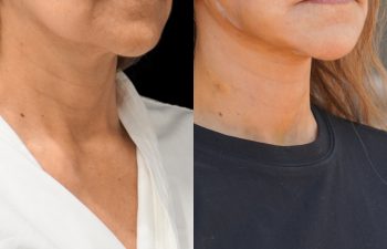 female patient before and after EVELIFT®