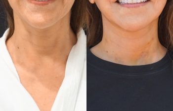 female patient before and after EVELIFT®