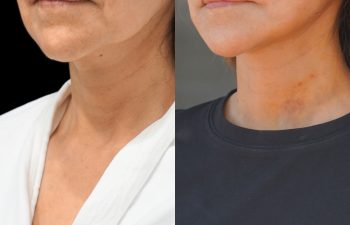 female patient before and after EVELIFT®